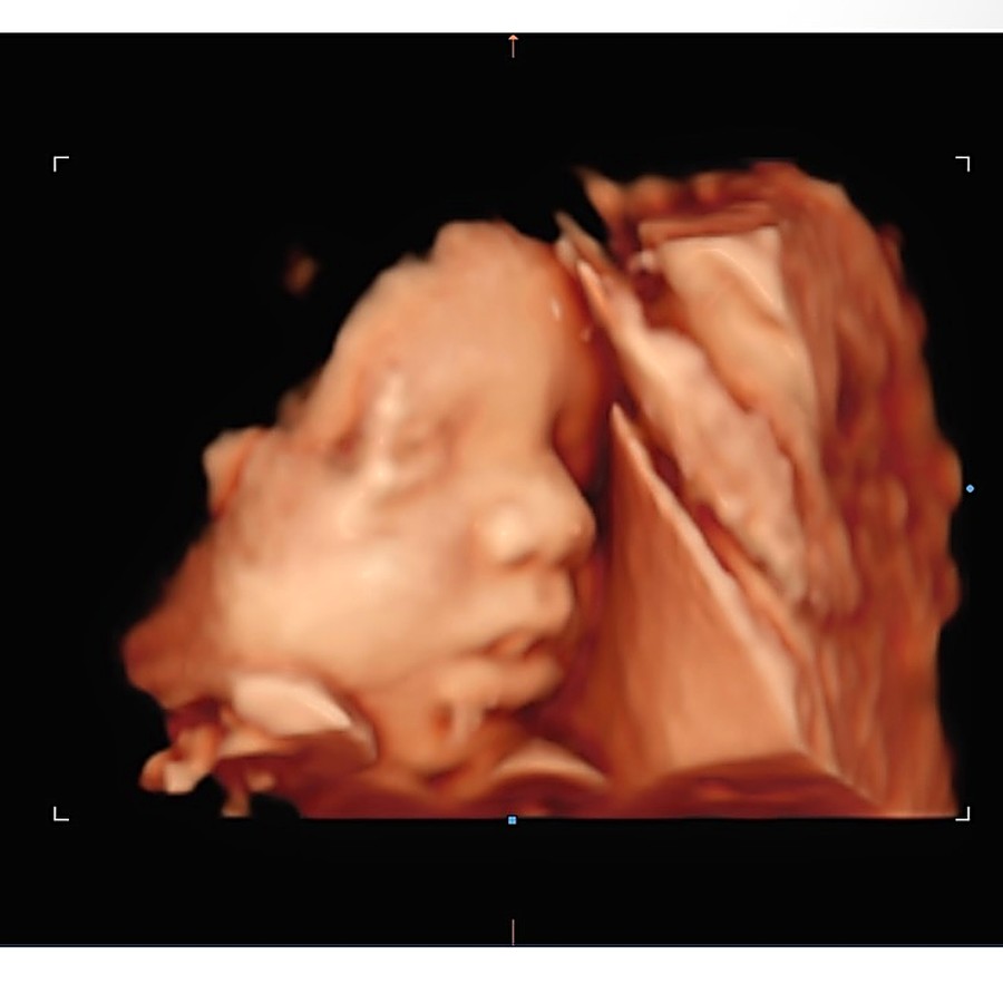 Imagem de ultrassom 3D do rosto de um bebê